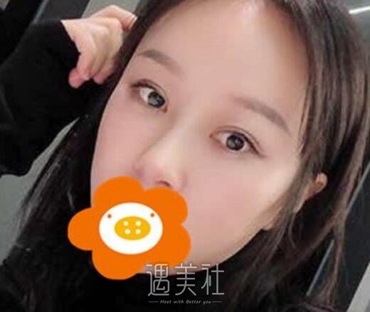 汪立川,隆鼻