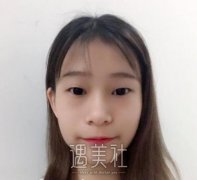 甘泉涌双眼皮案例：小眼妹成为大眼妹的逆袭~ width=
