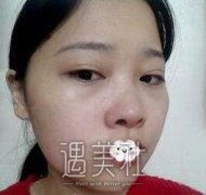 柳大烈颧骨案例：拍照再也不用P图啦~ width=