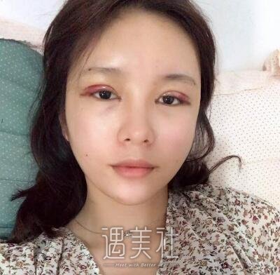上海九院张余光双眼皮案例|果较为理想!
