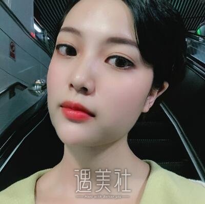 埋线双眼皮案例及对比图分享，前后变化真的很大!