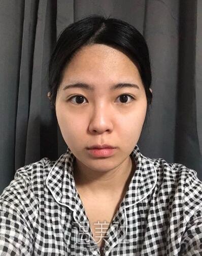 北京美莱欧阳春鼻修复案例|拥有了人见人爱的鼻子!