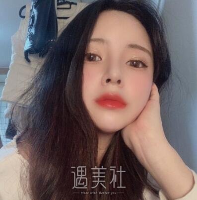 北京美莱欧阳春鼻修复案例|拥有了人见人爱的鼻子!