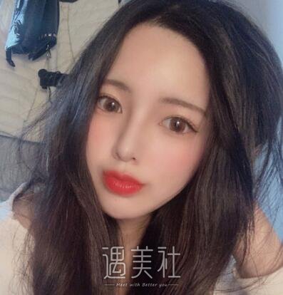 北京美莱欧阳春鼻修复案例|拥有了人见人爱的鼻子!