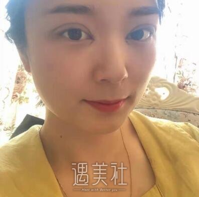 徐晓斐双眼皮修复案例|重归美女行列!
