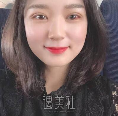 徐晓斐双眼皮修复案例|重归美女行列!