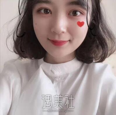 徐晓斐双眼皮修复案例|重归美女行列!