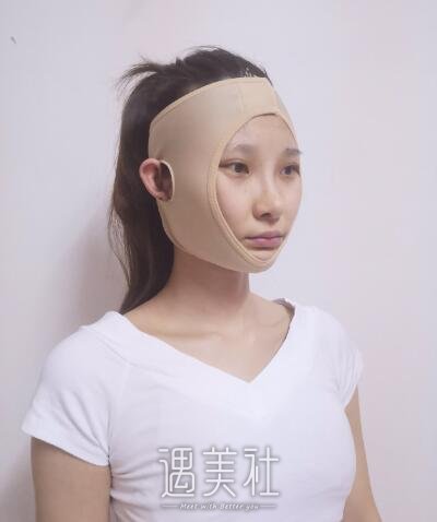 郑延清做颧骨案例分享|心情都变好了不少!