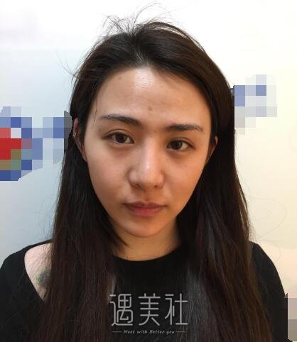 北京凯润婷白志鹏隆鼻案例|还真是看颜值的世界!