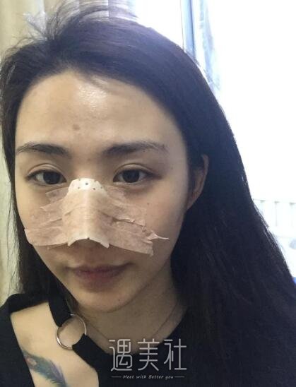 北京凯润婷白志鹏隆鼻案例|还真是看颜值的世界!