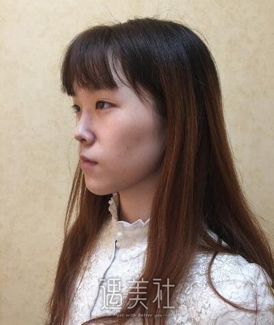 北京凯润婷宋长绪玻尿酸隆鼻案例|简单便捷见快!