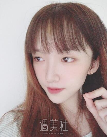 北京凯润婷宋长绪玻尿酸隆鼻案例|简单便捷见快!