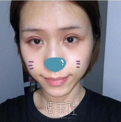 海医悦美常冬青双眼皮案例|拥有的双眼皮!
