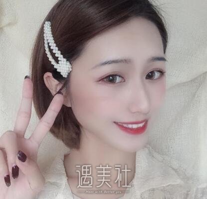海医悦美常冬青双眼皮案例|拥有的双眼皮!