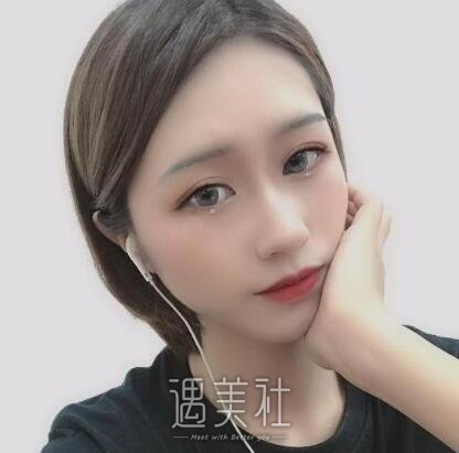 海医悦美常冬青双眼皮案例|拥有的双眼皮!