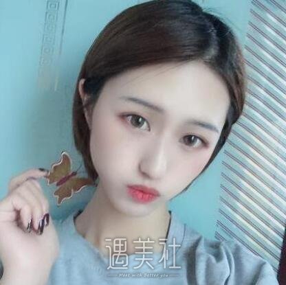 海医悦美常冬青双眼皮案例|拥有的双眼皮!