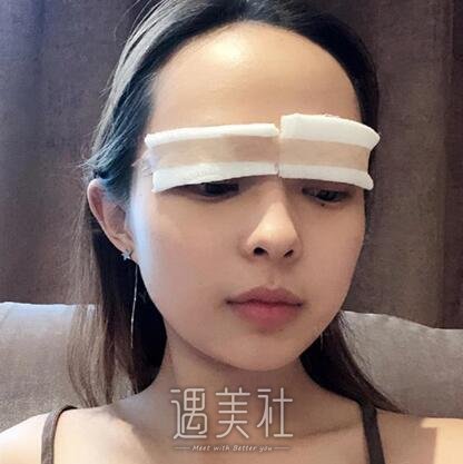 海医悦美林勇双眼皮案例|果真的很不错!
