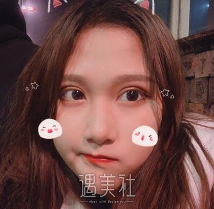 北京美莱杜园园双眼皮案例|人生出现了变化!