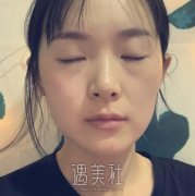华西医院割双眼皮案例分享 width=