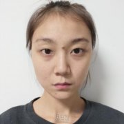 华西肖海涛双眼皮案例 width=