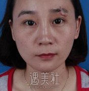 杨东运疤痕缝切案例 width=