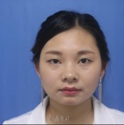 潘贰修复双眼皮失败案例 width=