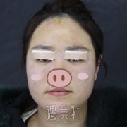 市一医院贾明割双眼皮果如何?有真实案例吗? width=