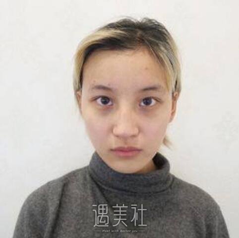 杨明勇,双眼皮修复