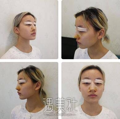 杨明勇,双眼皮修复