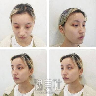杨明勇,双眼皮修复