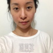 荆州名韩做双眼皮有多棒，你看看我的案例就知道了~ width=