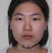 lj医美双眼皮能有多好看?案例对比图走一波~ width=