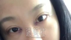 芳艺整形双眼皮案例分享：技术有多好就有多自然~ width=