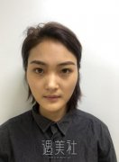 沧州中心医院整形外科价格表|自体脂肪丰脸案例果惨不忍睹~ width=