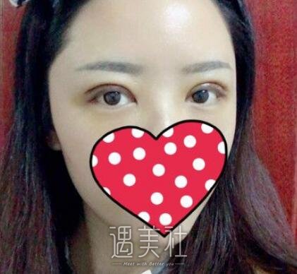 吉大一院整形,科割双眼皮