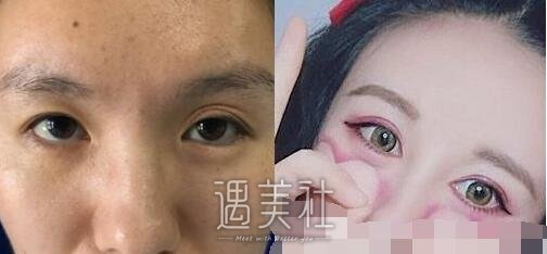 昆明,附二院整形科,肖鸿