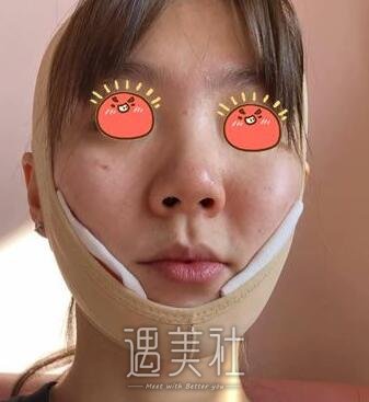 上海,九院,韦敏,磨骨