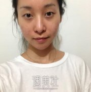 唐都医院整形科双眼皮恢复前后对比：就是内味呢~ width=