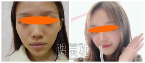 上海,九院,隆鼻