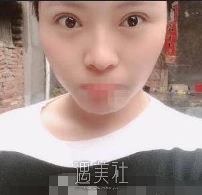 芳艺整形双眼皮