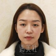 林登文整形案例图片：双眼皮恢复分享~ width=