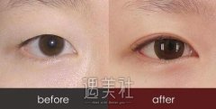 北京八大处双眼皮价格大概是多少，价格贵不贵? width=