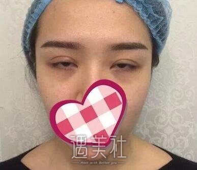 靳小雷双眼皮案例