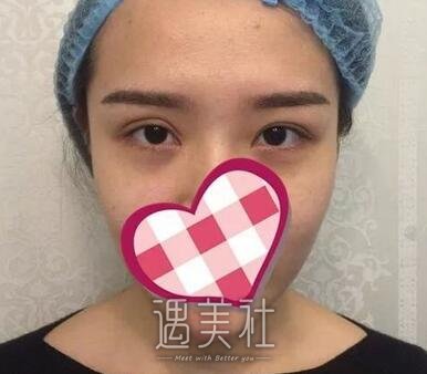 靳小雷双眼皮案例