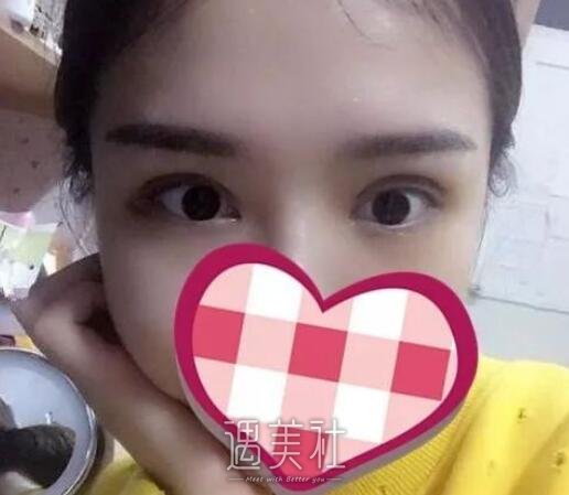 靳小雷双眼皮案例