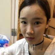 朱灿博士隆鼻案例图片：已经一年了 width=