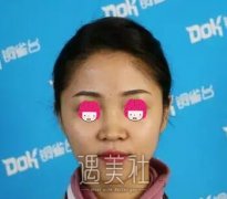 李信奎隆鼻案例：术后两个月果展示 width=