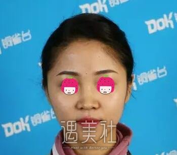 李信奎,隆鼻