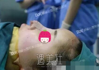 李信奎,隆鼻