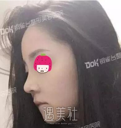 李信奎,隆鼻